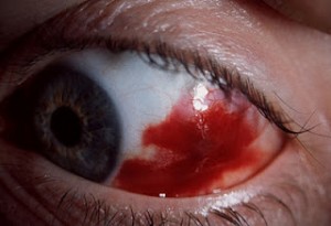 Subconjunctival haemorrhage 300x205